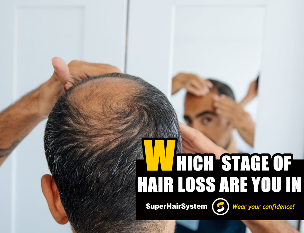 Which Stage of Hair Loss Are You in ？