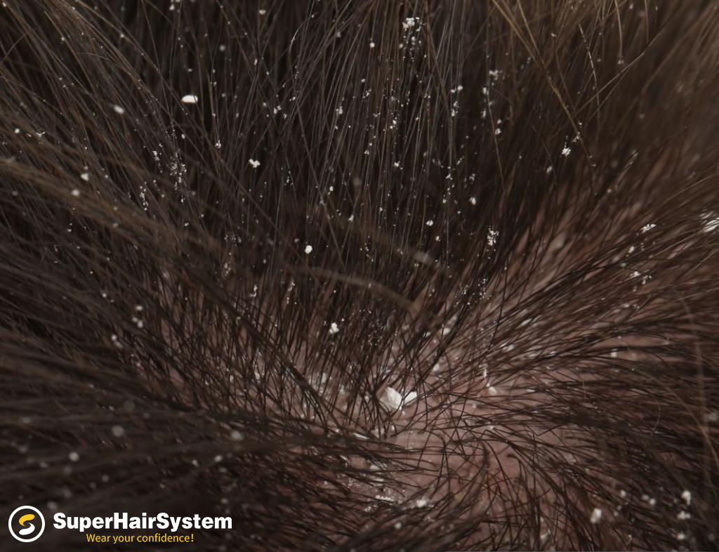 Dandruff on the head